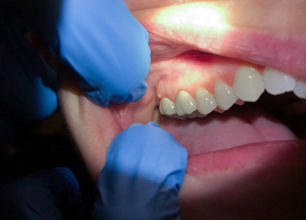 Emergency Dentist for Special Needs Patients