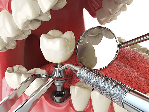 Best Emergency Dental Extractions in Fairfax, CA